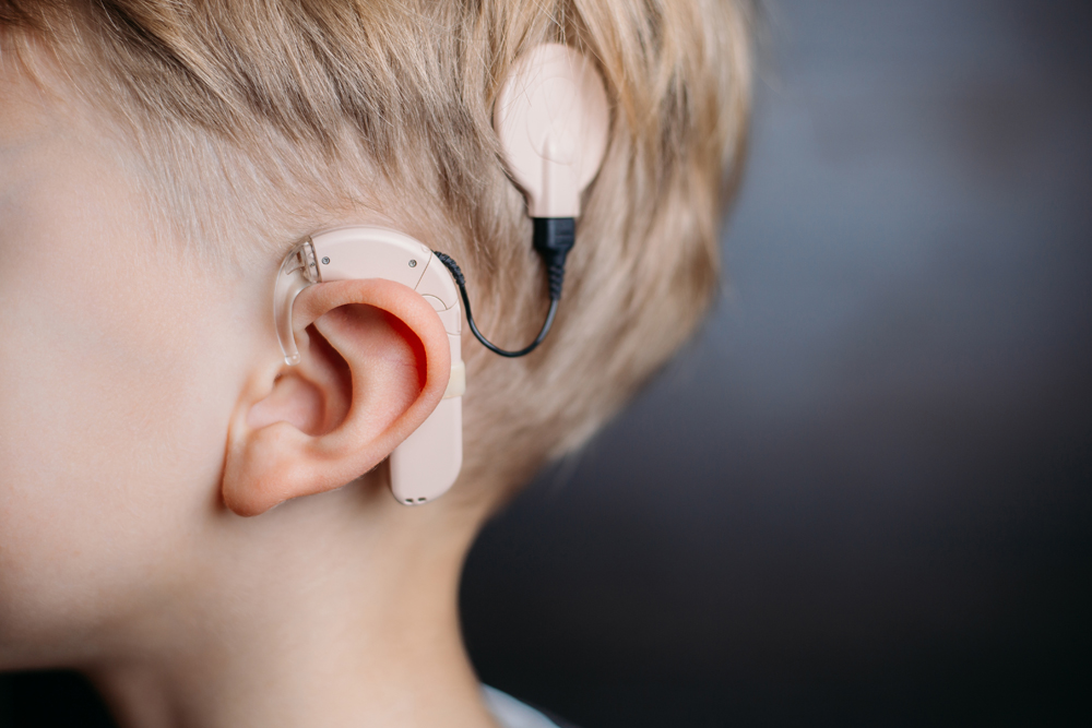 ๐ Cochlear Implant โ Restoring the Gift of Hearing!